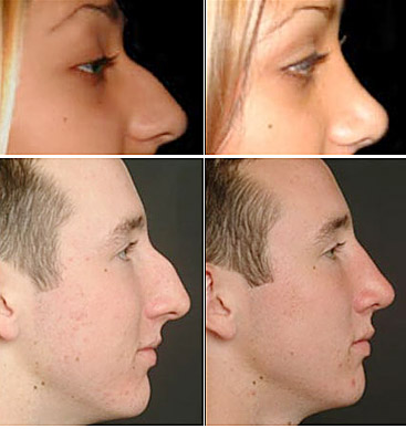 Nose Plastic Surgery on Nose Plastic Surgery